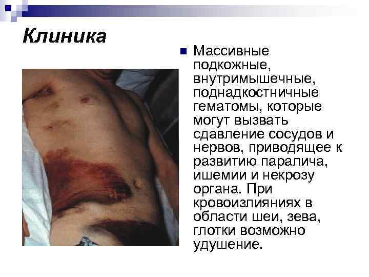 Клиника n Массивные подкожные, внутримышечные, поднадкостничные гематомы, которые могут вызвать сдавление сосудов и нервов,