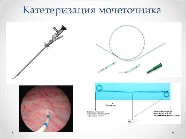 Катетеризация мочеточника 