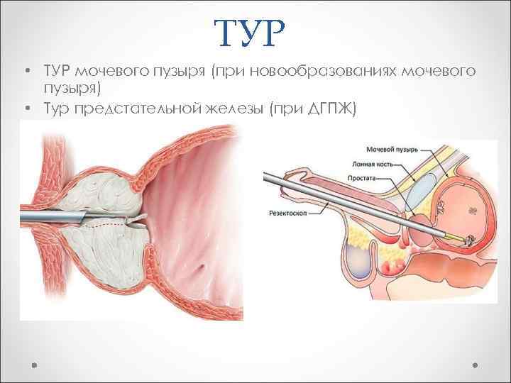 ТУР • ТУР мочевого пузыря (при новообразованиях мочевого пузыря) • Тур предстательной железы (при