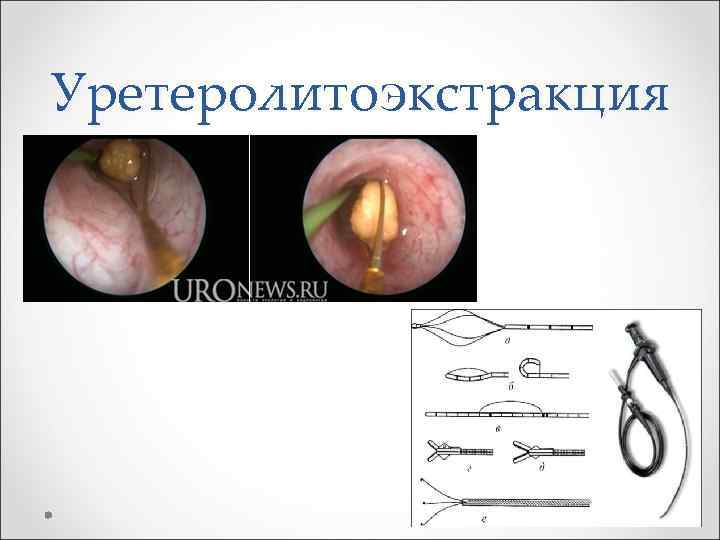 Уретеролитоэкстракция 