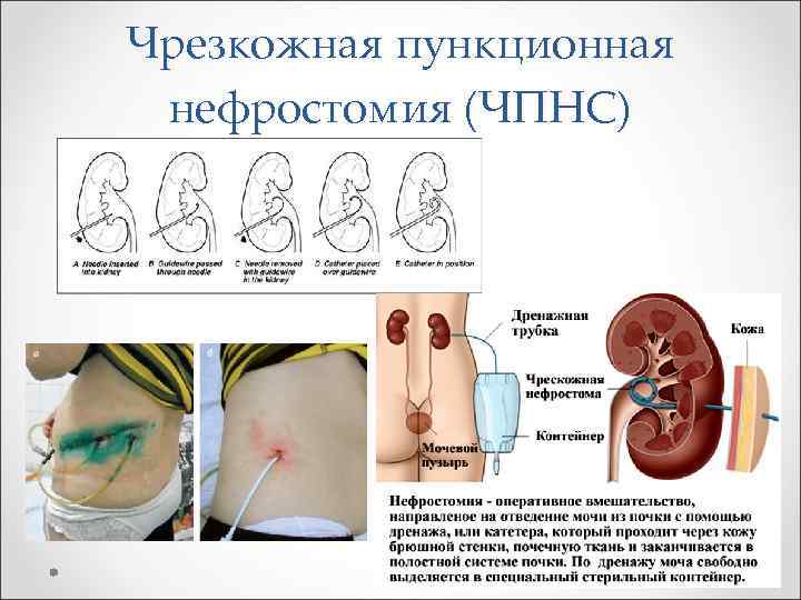 Чрезкожная пункционная нефростомия (ЧПНС) 