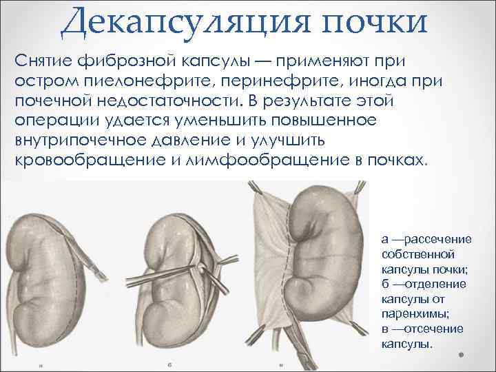 Декапсуляция почки Снятие фиброзной капсулы — применяют при остром пиелонефрите, перинефрите, иногда при почечной