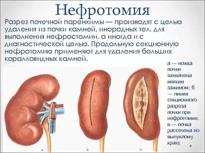 Нефротомия Разрез почечной паренхимы — производят с целью удаления из почки камней, инородных тел,
