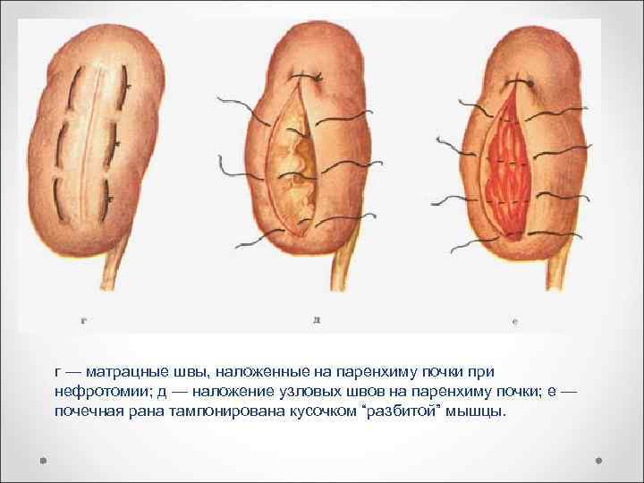 г — матрацные швы, наложенные на паренхиму почки при нефротомии; д — наложение узловых
