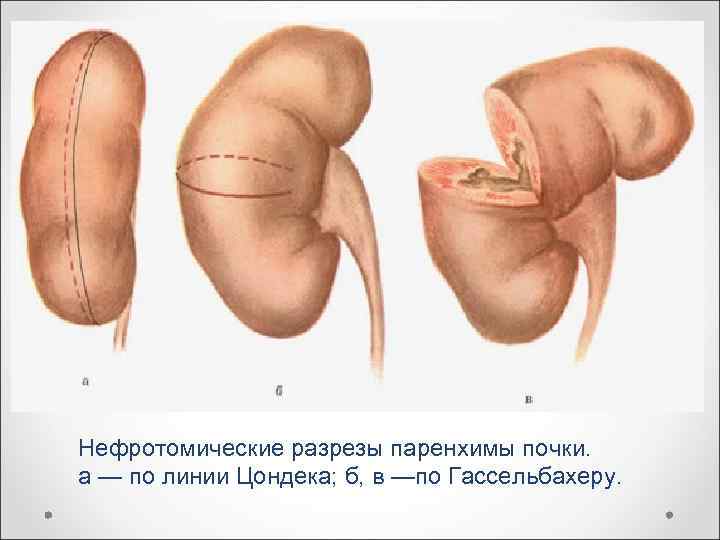 Нефротомические разрезы паренхимы почки. а — по линии Цондека; б, в —по Гассельбахеру. 