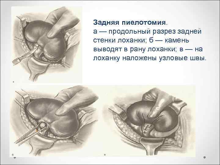 Задняя пиелотомия. а — продольный разрез задней стенки лоханки; б — камень выводят в