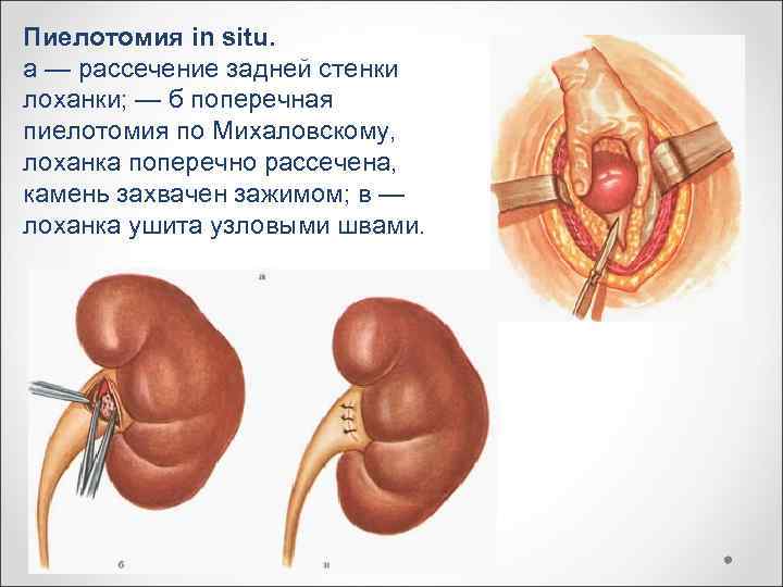 Пиелотомия in situ. a — рассечение задней стенки лоханки; — б поперечная пиелотомия по