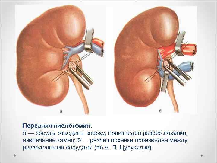 Передняя пиелотомия. а — сосуды отведены кверху, произведен разрез лоханки, извлечение камня; б —