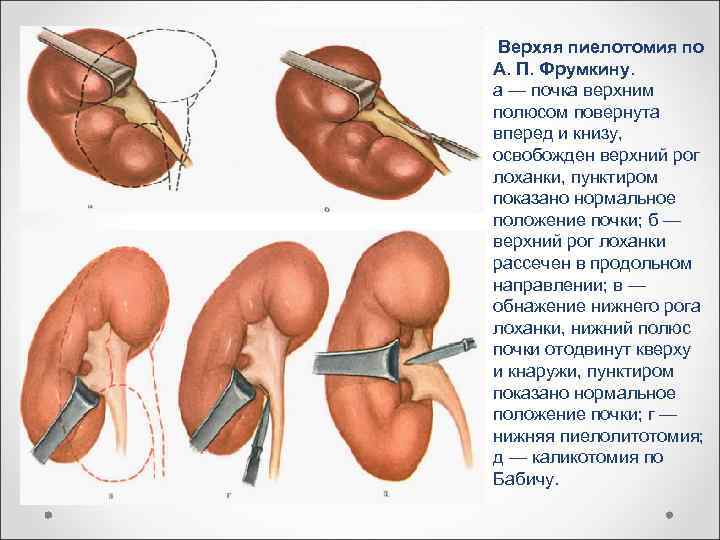  Верхяя пиелотомия по А. П. Фрумкину. а — почка верхним полюсом повернута вперед