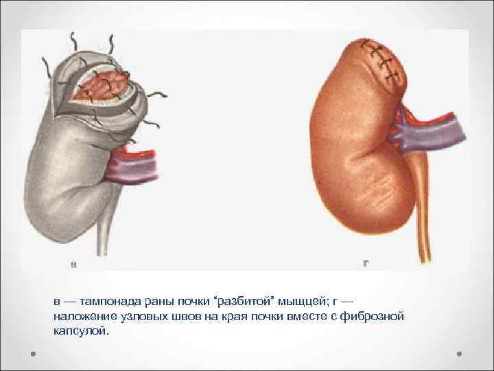 в — тампонада раны почки “разбитой” мыщцей; г — наложение узловых швов на края