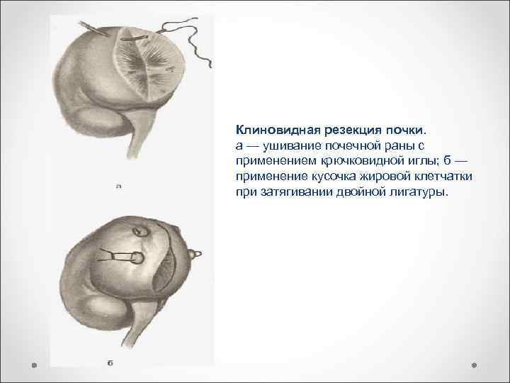 Клиновидная резекция почки. а — ушивание почечной раны с применением крючковидной иглы; б —