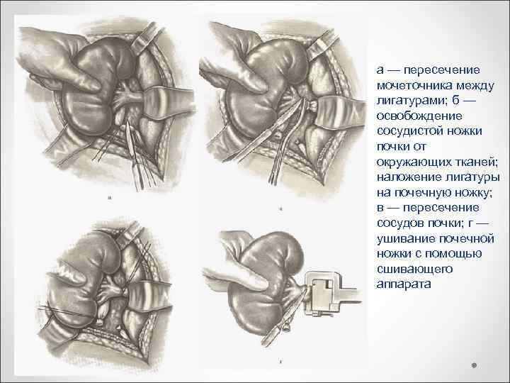 а — пересечение мочеточника между лигатурами; б — освобождение сосудистой ножки почки от окружающих