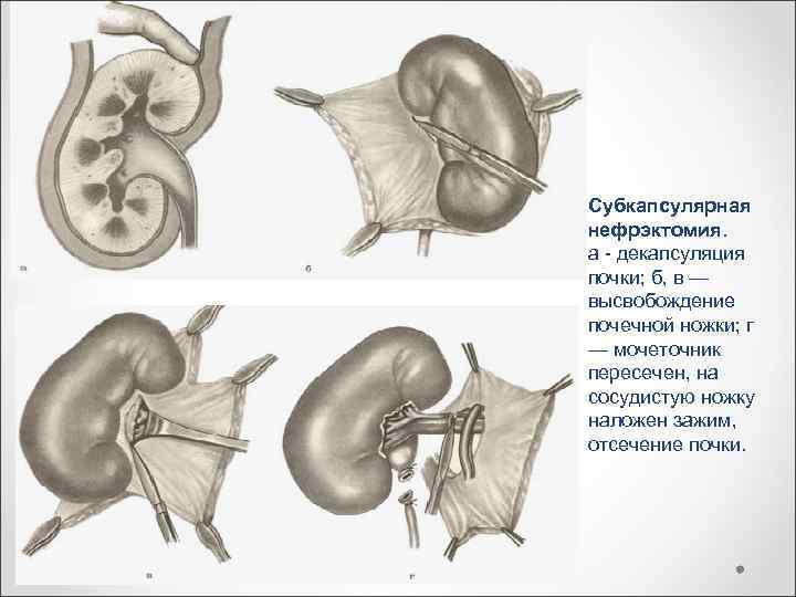 Субкапсулярная нефрэктомия. а - декапсуляция почки; б, в — высвобождение почечной ножки; г —