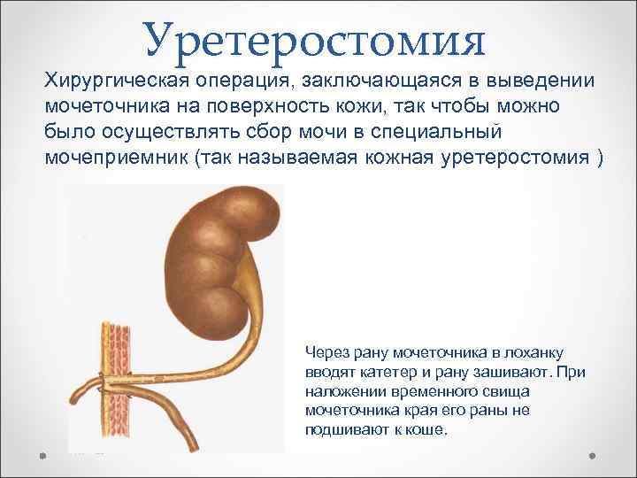 Уретеростомия Хирургическая операция, заключающаяся в выведении мочеточника на поверхность кожи, так чтобы можно было