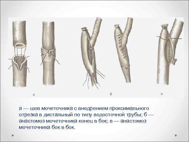 а — шов мочеточника с внедрением проксимального отрезка в дистальный по типу водосточной трубы;