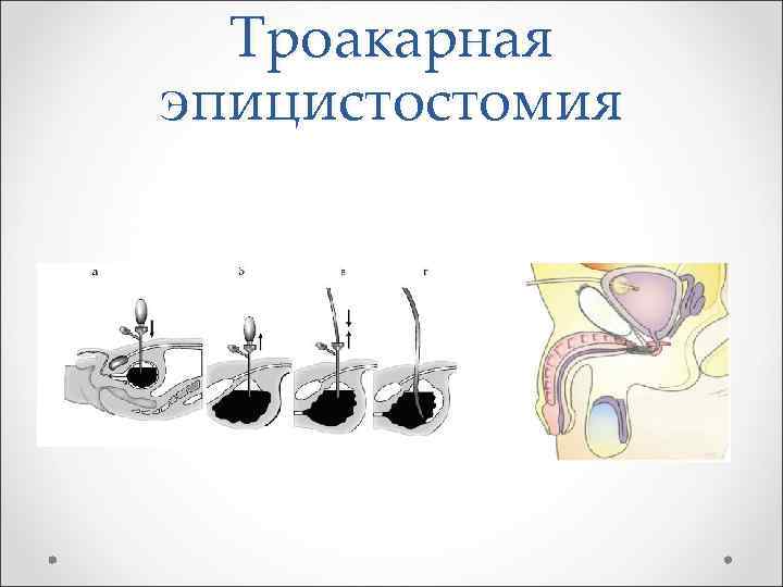 Троакарная эпицистостомия 