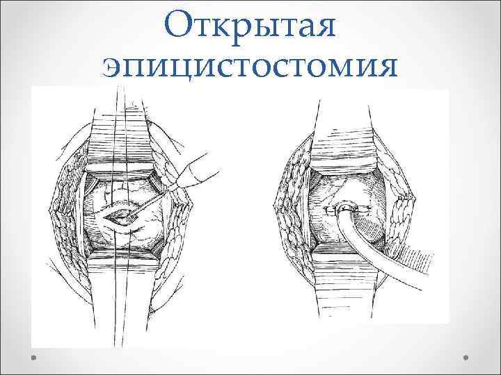 Открытая эпицистостомия 