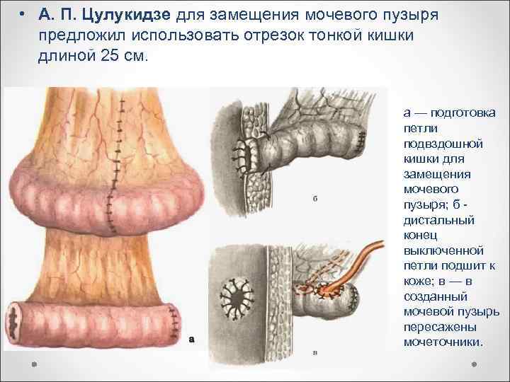  • А. П. Цулукидзе для замещения мочевого пузыря предложил использовать отрезок тонкой кишки