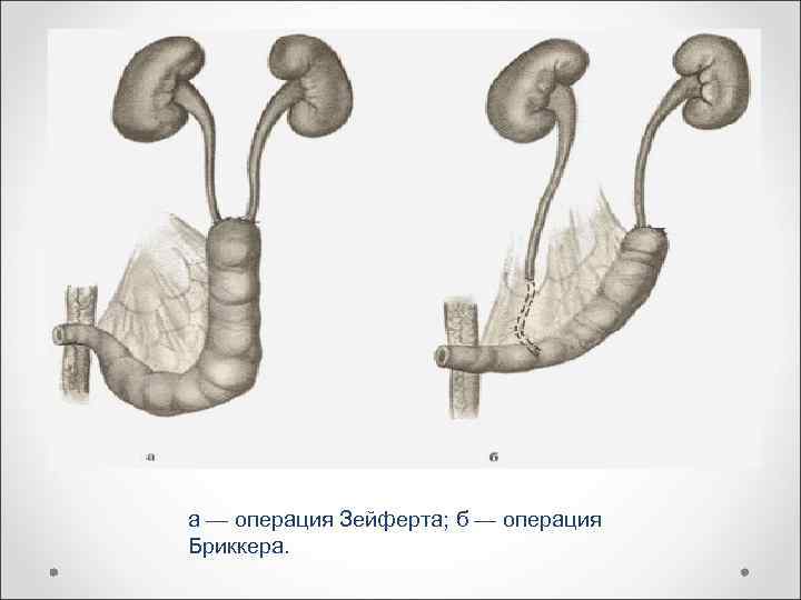 а — операция Зейферта; б — операция Бриккера. 