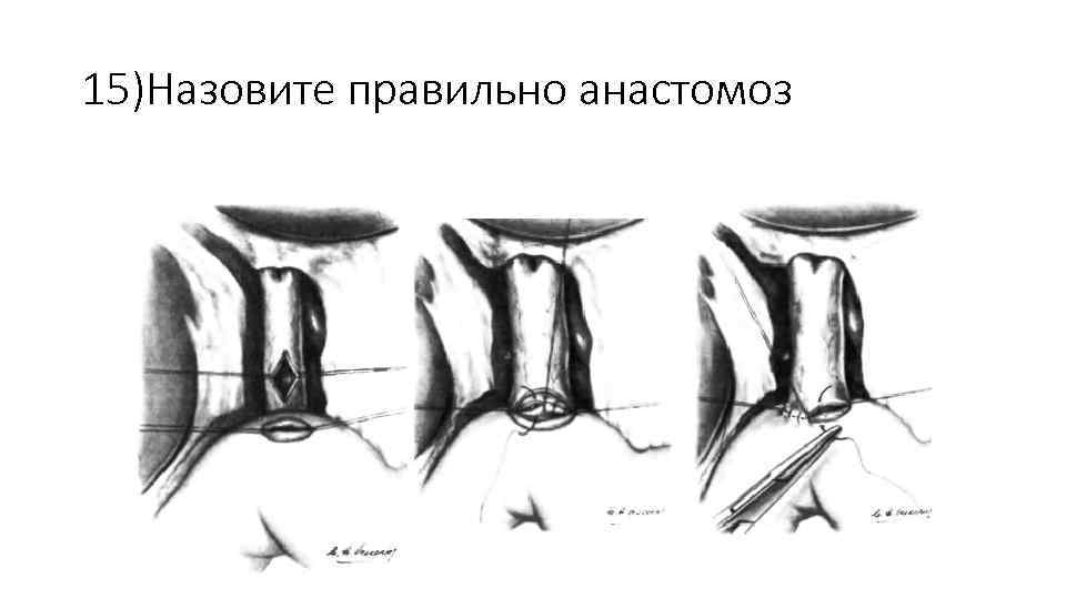 15)Назовите правильно анастомоз 