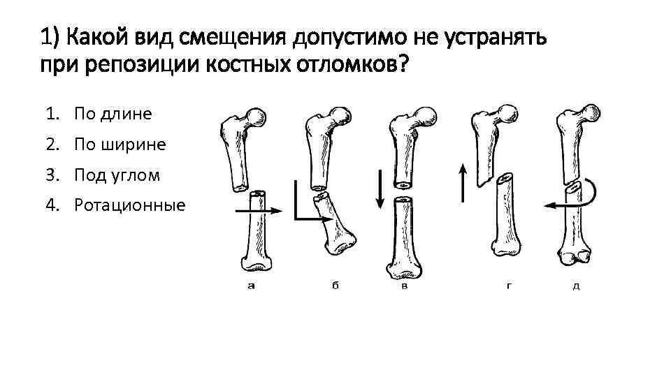1) Какой вид смещения допустимо не устранять при репозиции костных отломков? 1. По длине