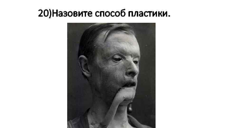 20)Назовите способ пластики. 