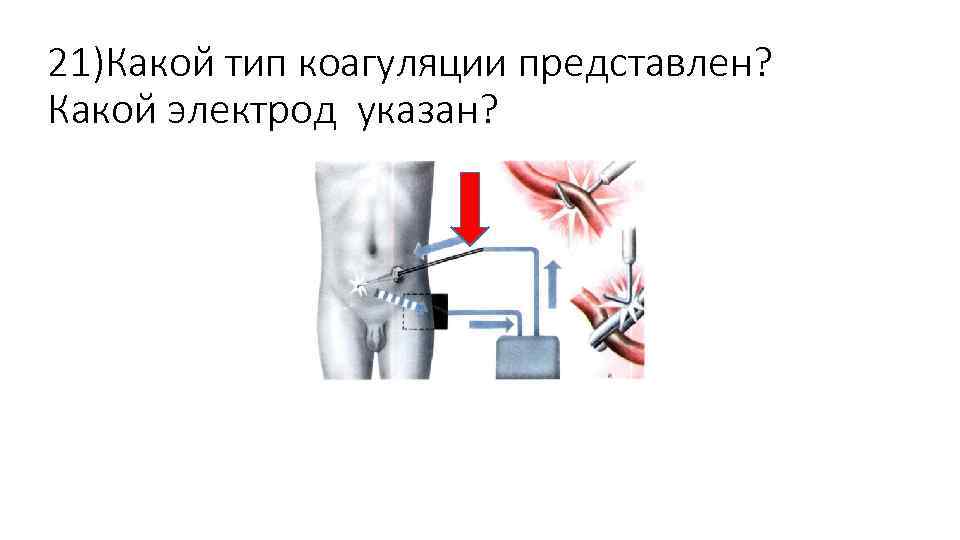 21)Какой тип коагуляции представлен? Какой электрод указан? 