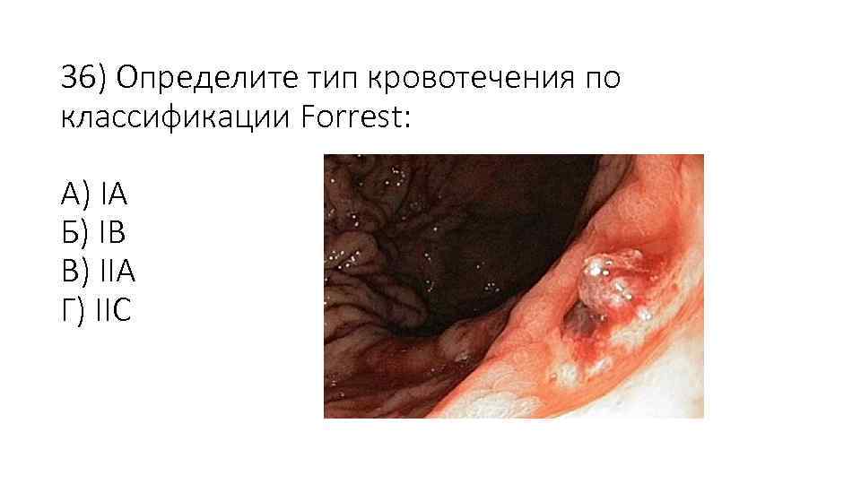 36) Определите тип кровотечения по классификации Forrest: А) IА Б) IB В) IIА Г)
