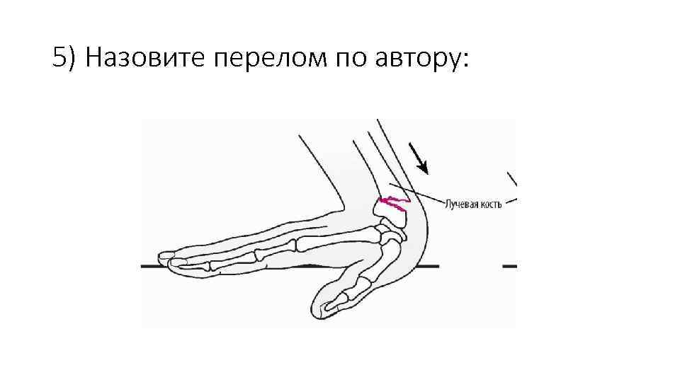 5) Назовите перелом по автору: 