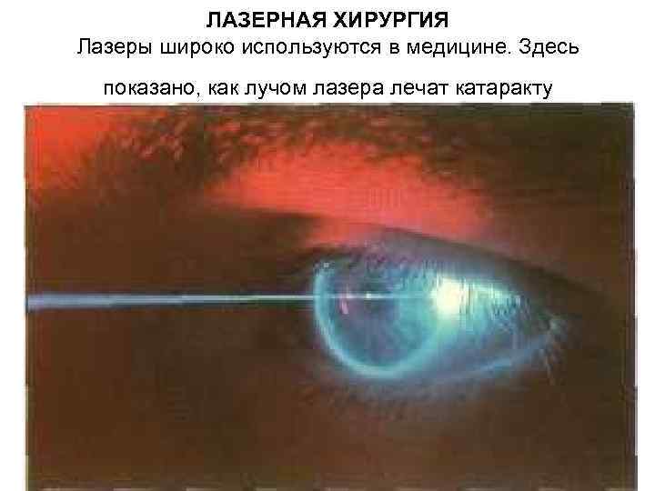 ЛАЗЕРНАЯ ХИРУРГИЯ Лазеры широко используются в медицине. Здесь показано, как лучом лазера лечат катаракту