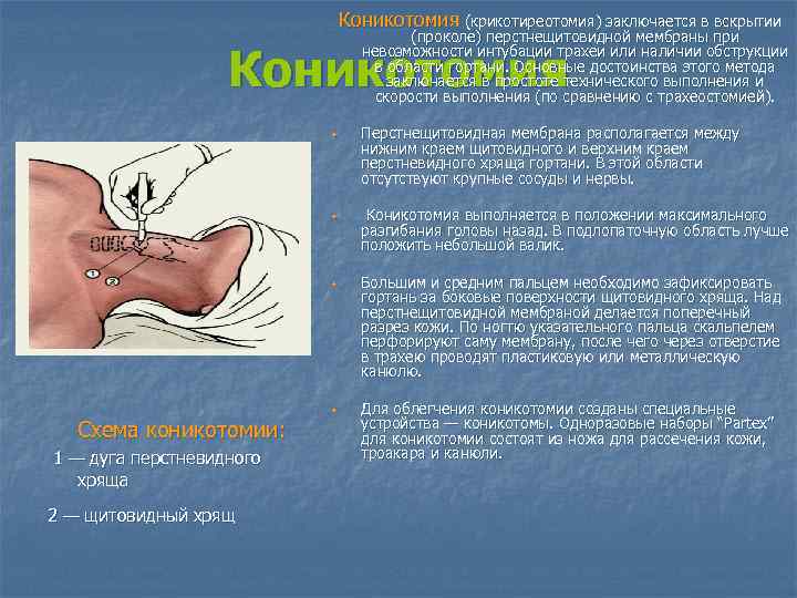 Коникотомия (крикотиреотомия) заключается в вскрытии (проколе) перстнещитовидной мембраны при невозможности интубации трахеи или наличии