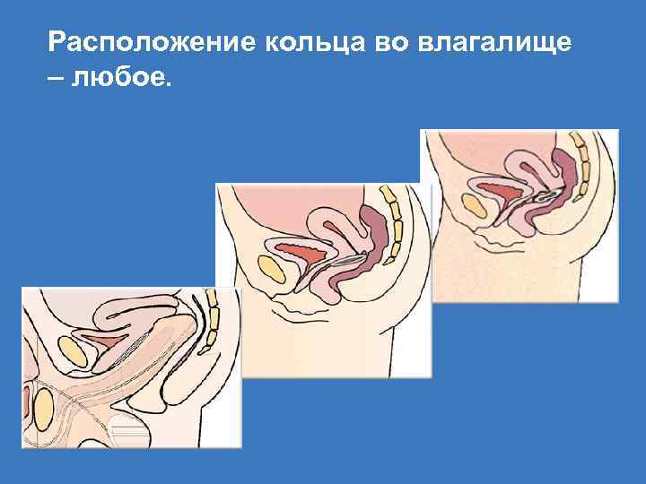 Расположение кольца во влагалище – любое. 