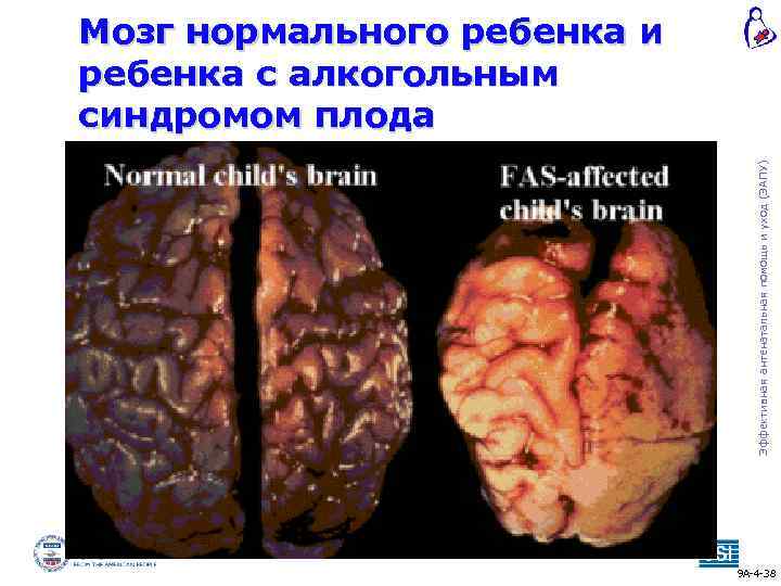 Эффективная антенатальная помощь и уход (ЭАПУ) Мозг нормального ребенка и ребенка с алкогольным синдромом