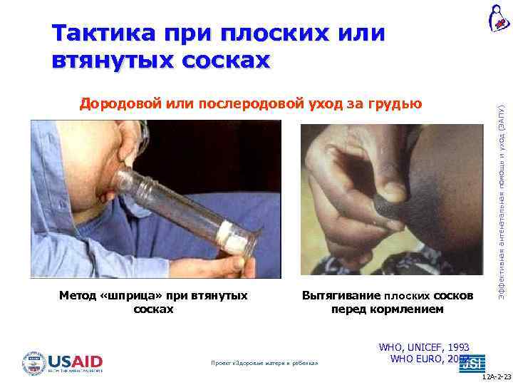 Дородовой или послеродовой уход за грудью Метод «шприца» при втянутых сосках Вытягивание плоских сосков