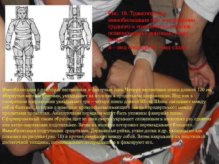 Рис. 18. Транспортная иммобилизация при повреждении грудного и поясничного отделов позвоночника с помощью узких