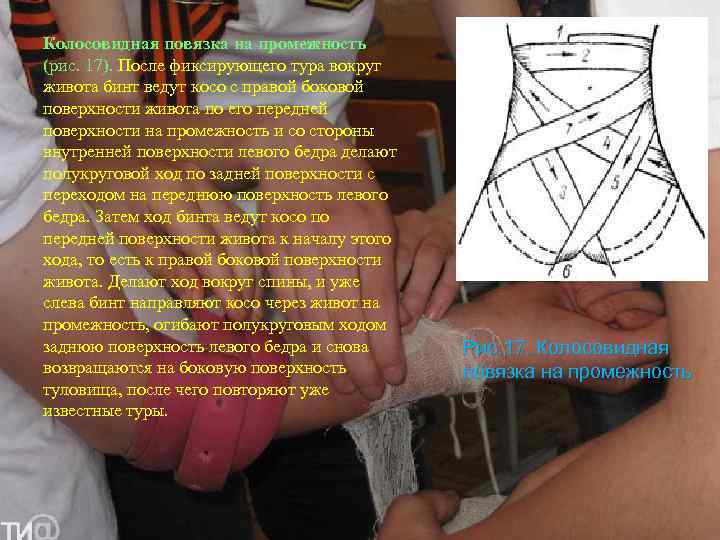 Колосовидная повязка на промежность (рис. 17). После фиксирующего тура вокруг живота бинт ведут косо