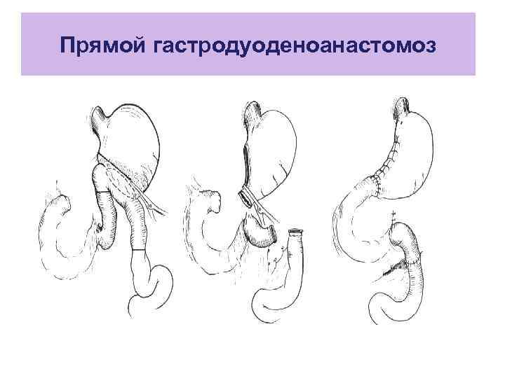 Результаты после резекции желудка фото