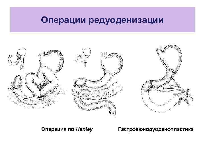 Операции редуоденизации Операция по Henley Гастроеюнодуоденопластика 