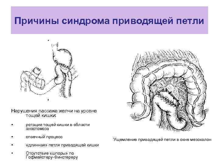 Результаты после резекции желудка фото