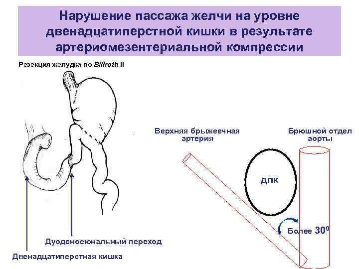 Резекция желудка для похудения фото до и после