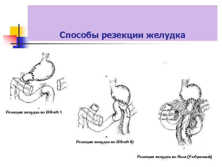 Результаты после резекции желудка фото