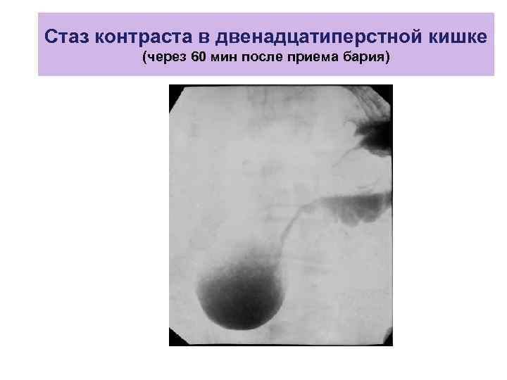 Результаты после резекции желудка фото