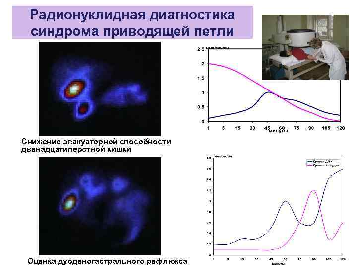 Радионуклидная диагностика синдрома приводящей петли Снижение эвакуаторной способности двенадцатиперстной кишки Оценка дуоденогастрального рефлюкса 