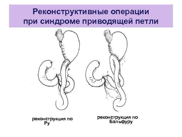 Операции по бильрот 1 и 2 схема