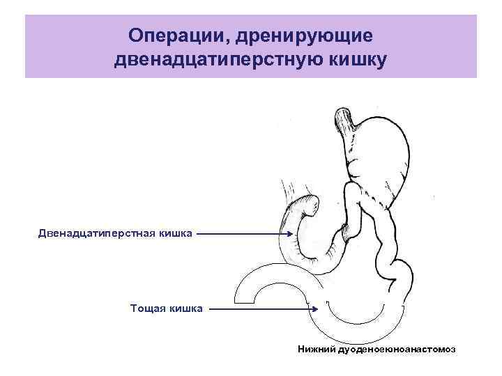 Недостаточность илеоцекального клапана кишечника