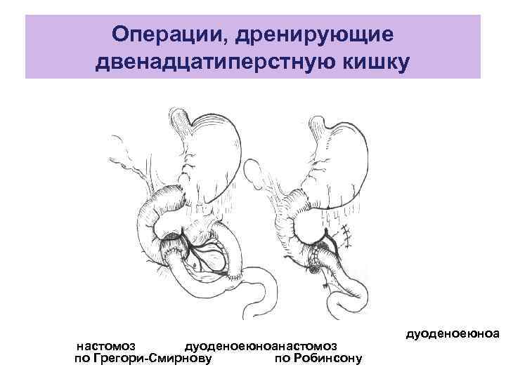 Операции, дренирующие двенадцатиперстную кишку настомоз дуоденоеюноанастомоз по Грегори-Смирнову по Робинсону дуоденоеюноа 