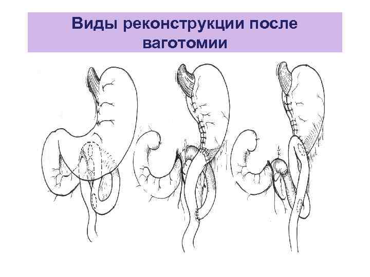 Резекция желудка по витебскому схема операции