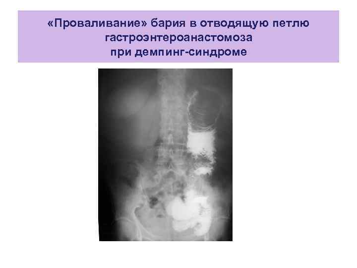 Стол после резекции желудка