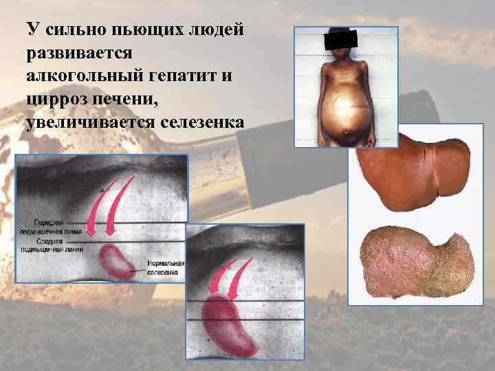 У сильно пьющих людей развивается алкогольный гепатит и цирроз печени, увеличивается селезенка 