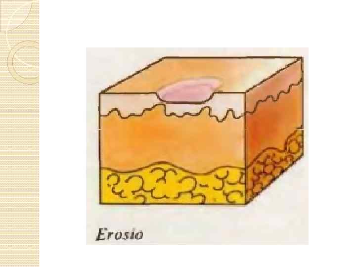Рисунки эрозий. Вторичные морфологические элементы кожи лихенификация. Эрозия вторичный элемент сыпи. Вторичные элементы сыпи экскориация.